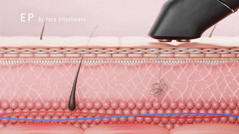 イーポレーション・シュプリームのエレクトロポレーション(EP)使用時の様子