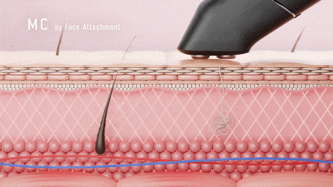 イーポレーション・シュプリームのマイクロカレント(MC)使用時の様子