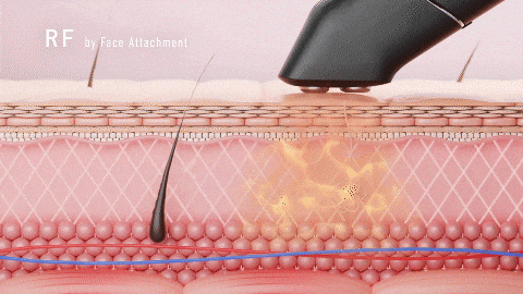 イーポレーション・シュプリームのラジオ波(RF)使用時の様子